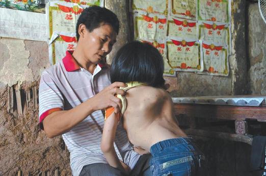 有嚴(yán)重脊椎畸形及胸腔隆突病的李文霞。
