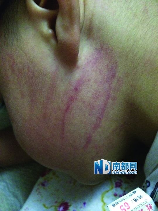 小逸臉上淤痕清晰可見。