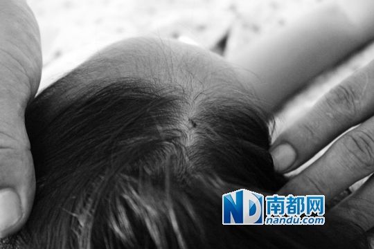女童頭上被扎的針孔（圓圈處）。賈先生說，被扎不到三秒鐘，女兒就昏了。
