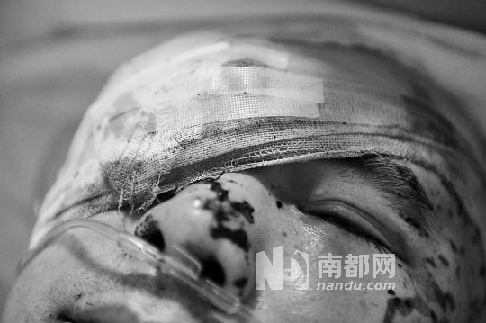 李建新頭部還有被潑硫酸的痕跡，醫(yī)生說被砍傷的右眼已經(jīng)失明。 南都記者 田飛 攝