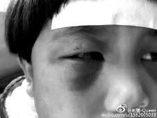 6月2日，網(wǎng)曝渭南市臨渭區(qū)一不滿5歲的女童遭奶奶毆打，眼圈青腫，引起網(wǎng)友關(guān)注，但孩子父母和爺爺均稱是摔倒導(dǎo)致。相關(guān)部門介入調(diào)查發(fā)現(xiàn)確為奶奶毆打所致，鑒于其身體原因已進行批評教育。