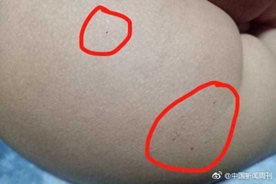 據(jù)多名紅黃藍(lán)(新天地分園)家長反映，孩子腿部、屁股、腋下出現(xiàn)針眼。