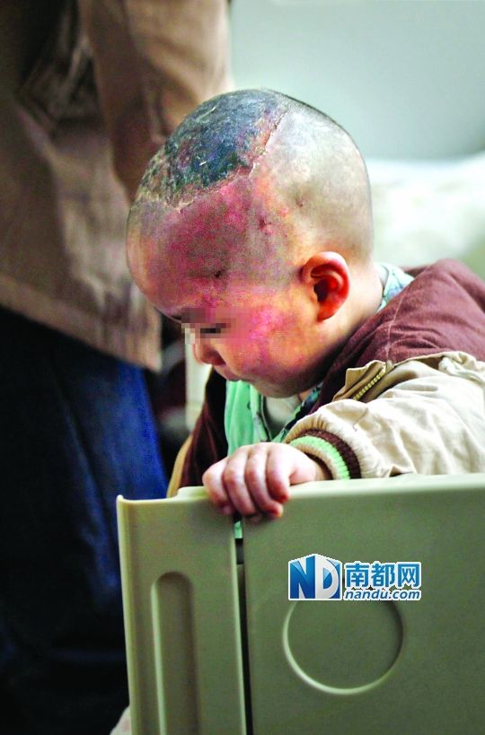1月8日下午，小寶頭上和臉上都是傷痕。