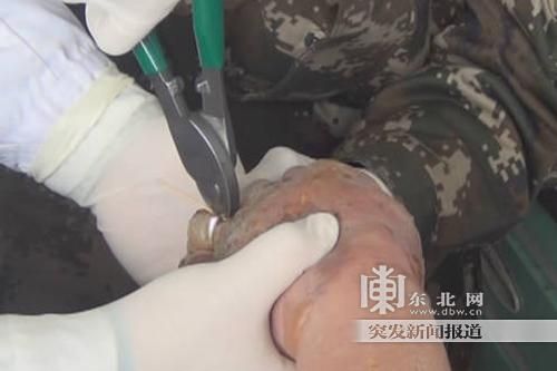正在拆除戒指。