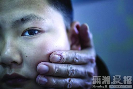 1月13日，小玨的父親心疼地摸著兒子的臉。